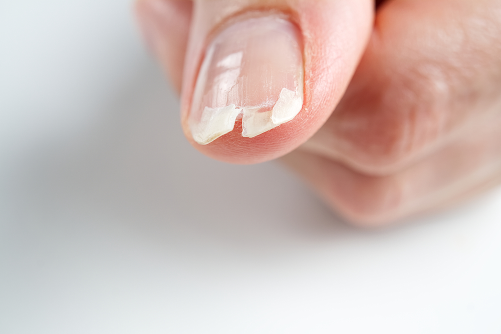 broken,nail,on,a,female,hand.,close up,shoot,of,broken